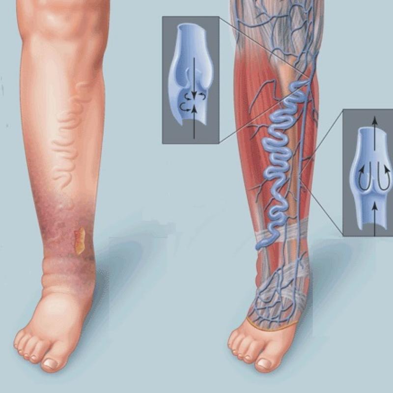 Где лечат вены. Варикозное расширение вен нижних конечностей ХВН. Хроническая венозная недостаточность (ХВН). Облитерирующий атеросклероз нижних конечностей.